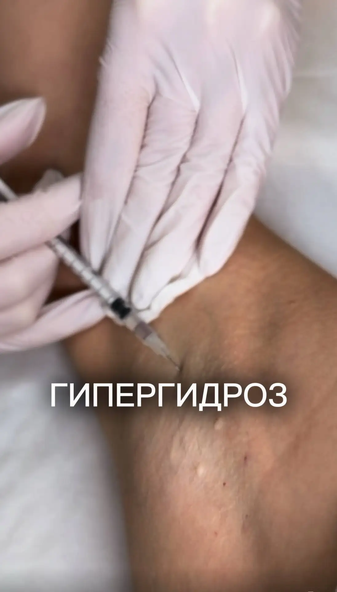 💦 Одна из самых востребованных процедур летом — лечение гипергидроза в СПб.