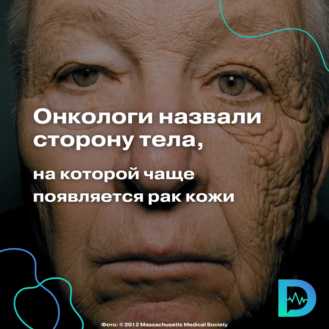 Вы знали, что рак кожи чаще возникает с левой стороны?

Это не миф, а наблюдение врачей. В странах с