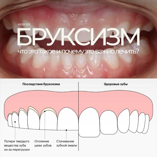 Скрежет зубами во сне: вредная привычка или болезнь? 🦷😬
