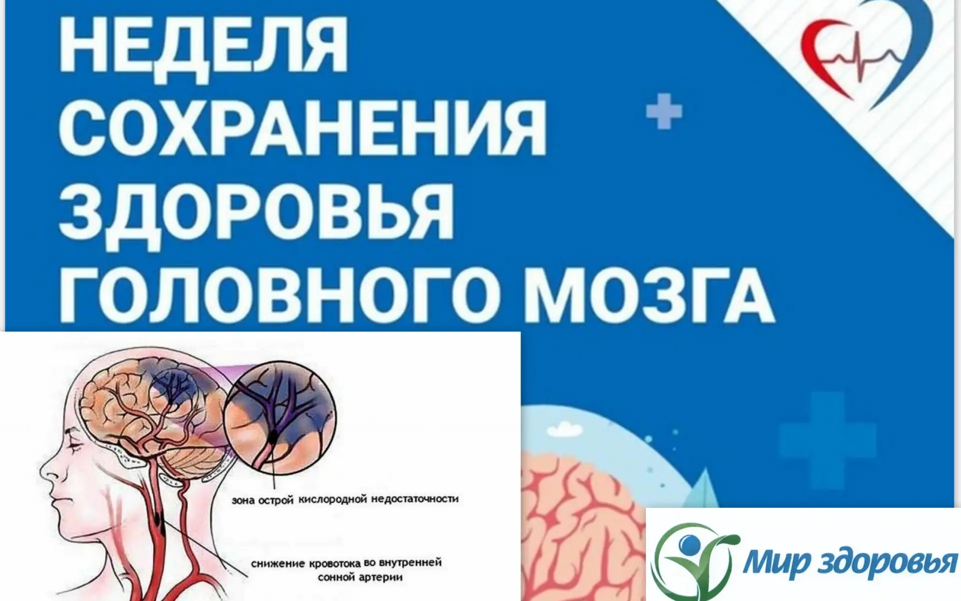 ИШЕМИЯ ГОЛОВНОГО МОЗГА, ЧЕМ ОПАСНА?
В рамках недели «Сохранения здоровья головного мозга» медики ГБУ