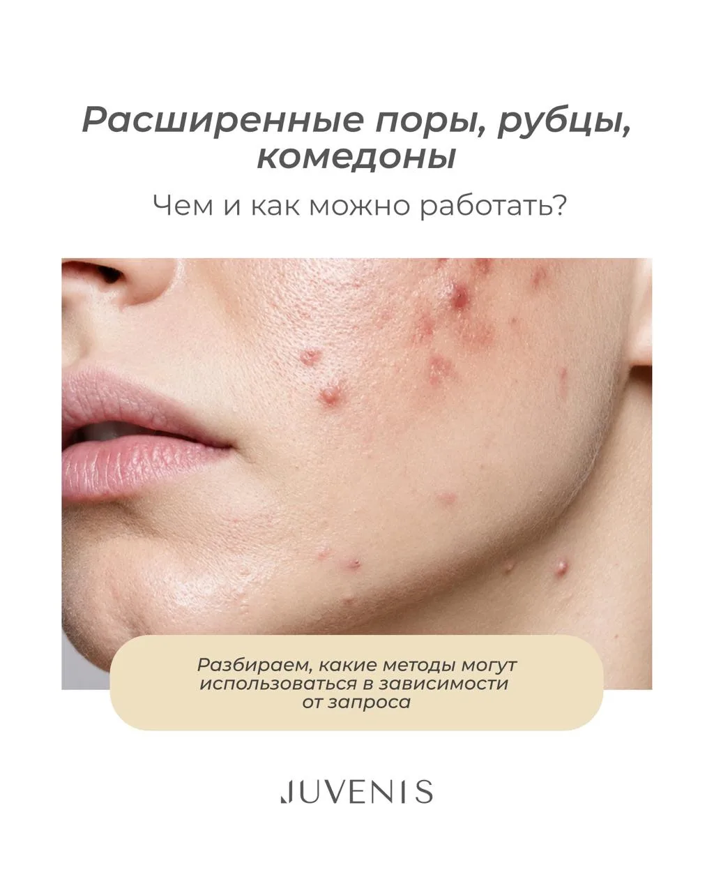 Расширенные поры, рубцы, комедоны – с чем и как можно работать?