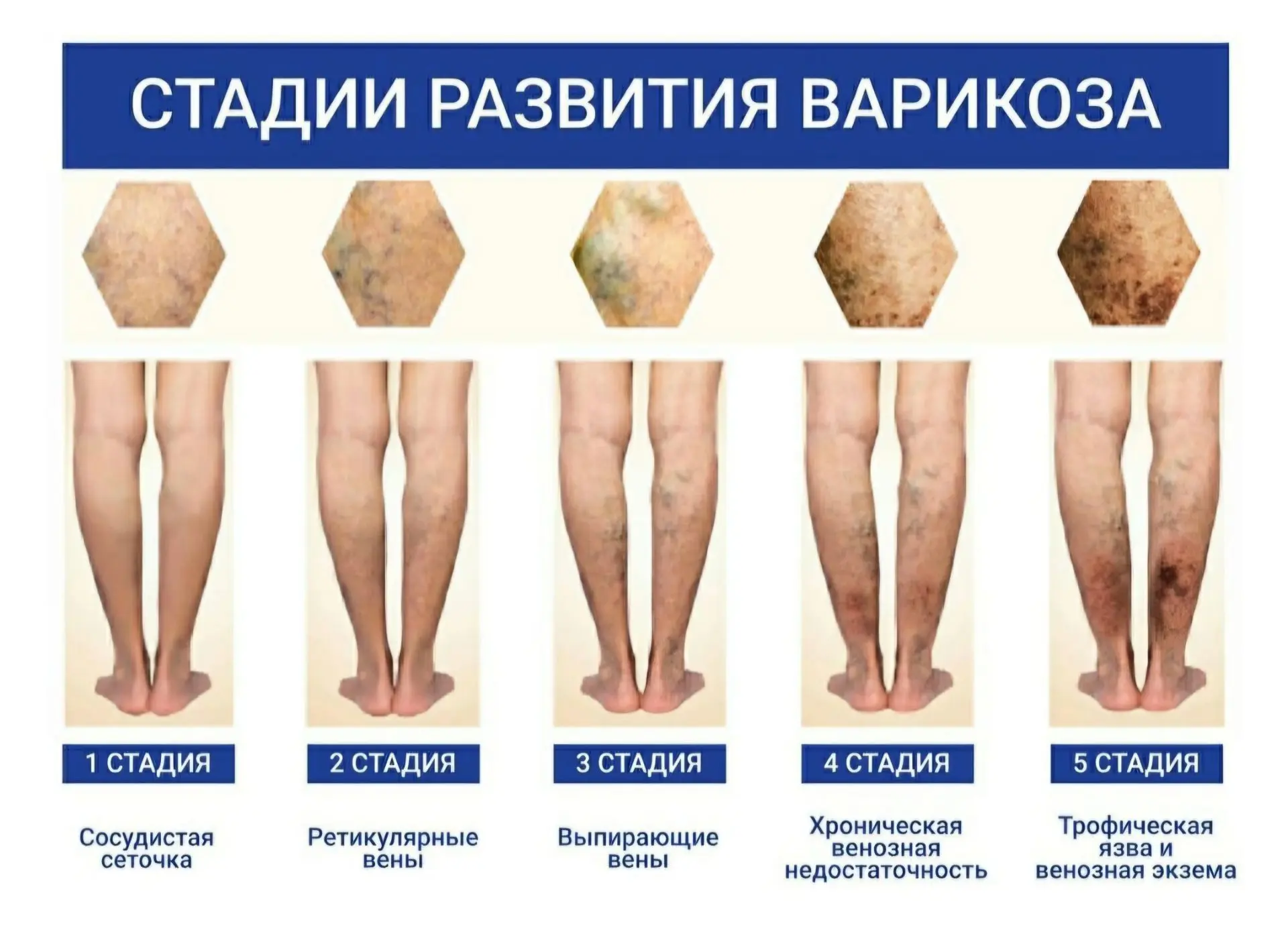 🦵Варикоз и фитнес: как тренироваться безопасно