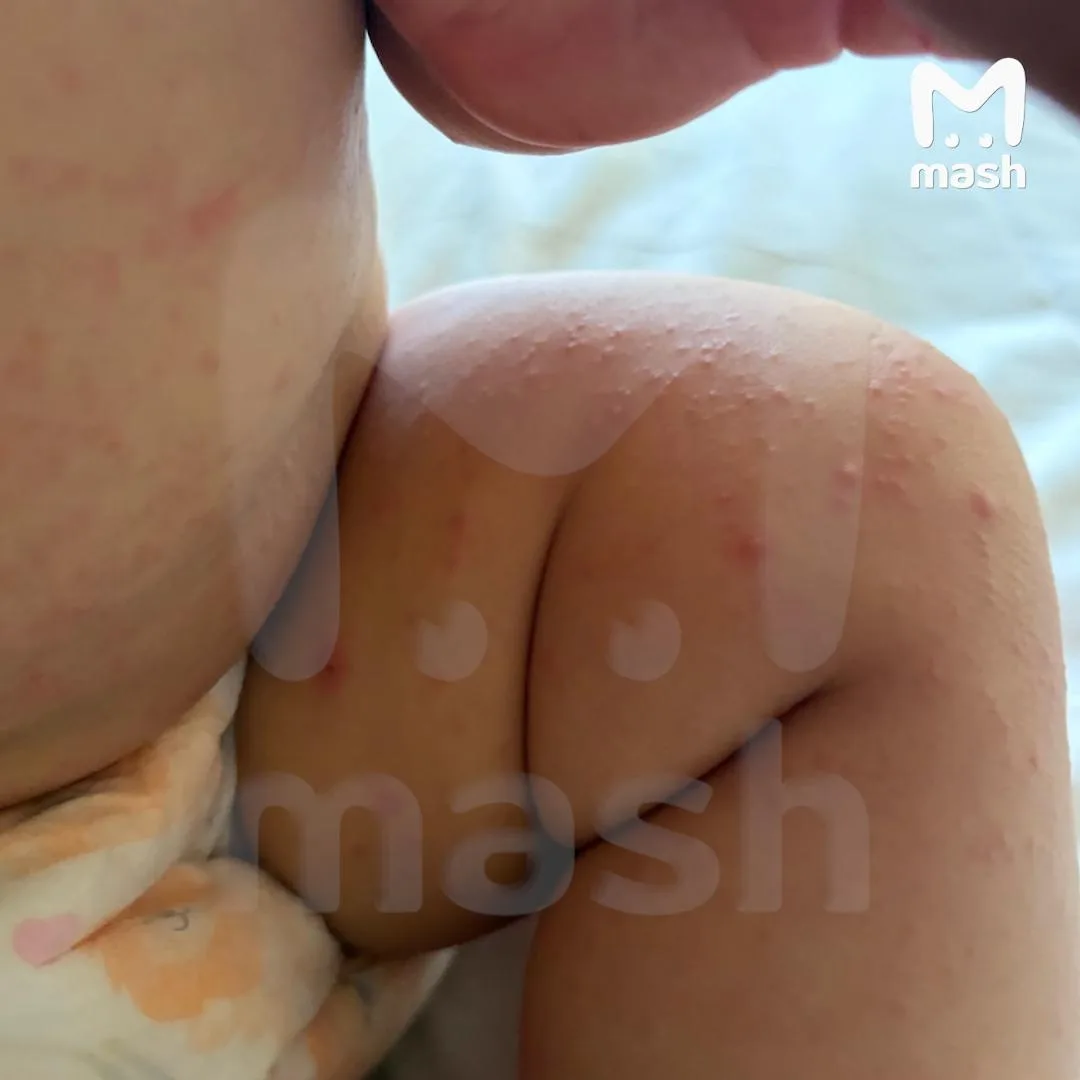 🤒 Семья из Тулы подхватила вирус Коксаки во время отдыха во Вьетнаме
