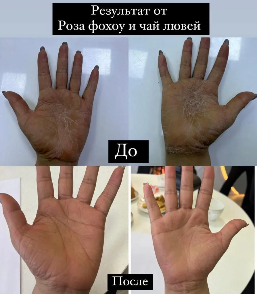 Роза Фохоу и чай Лювей.

Аллергическая экзема  

Выпила 5 тюбиков Роза фохоу и одну упаковку чай люв