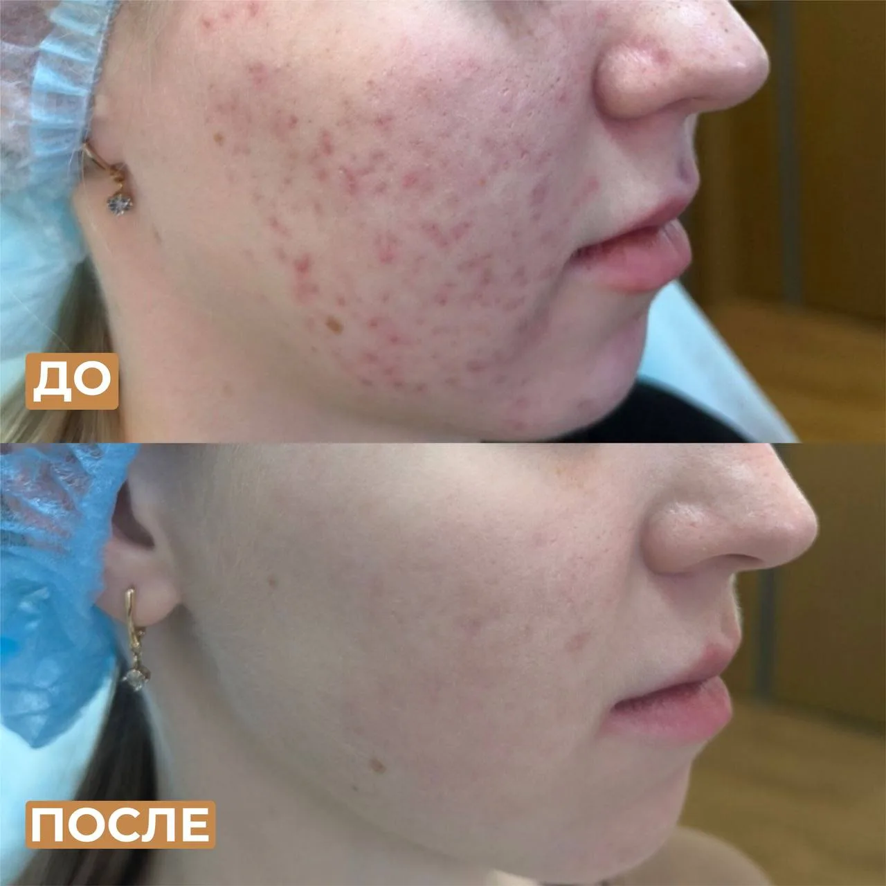 Понимание акне — ключ к успешному лечению 🌟