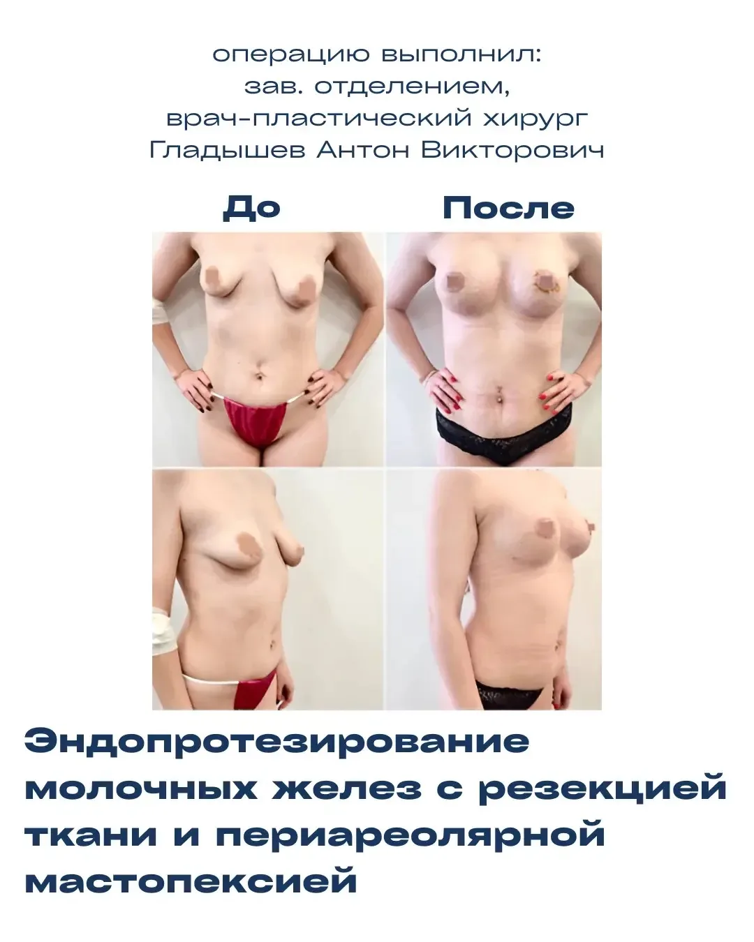 Сложный случай коррекции тубулярной формы груди

Пациентку беспокоили тубулярная деформация груди и 