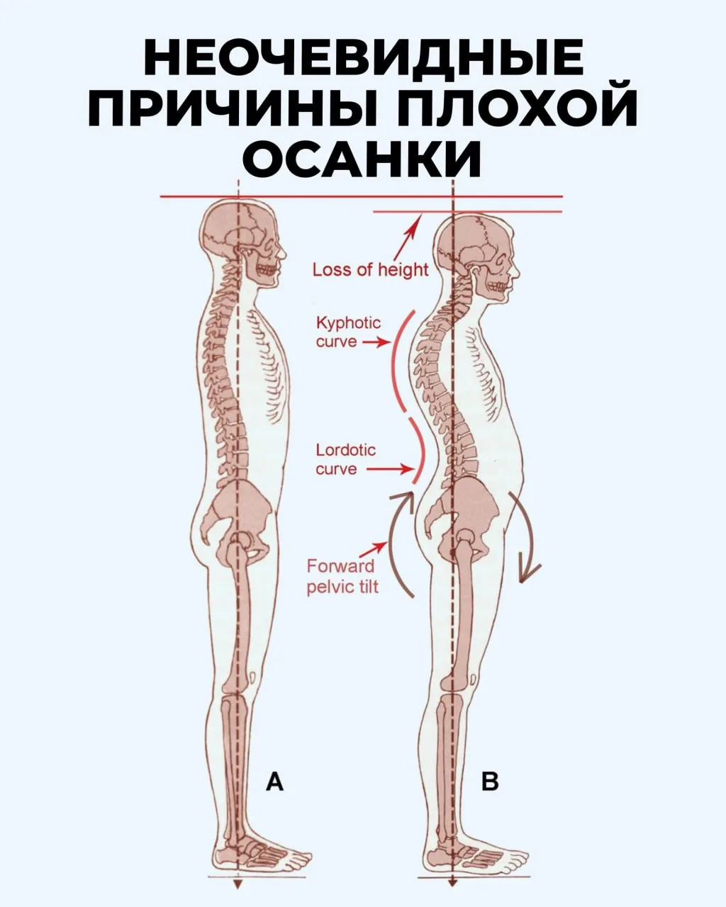КОМПЬЮТЕРНАЯ ШЕЯ