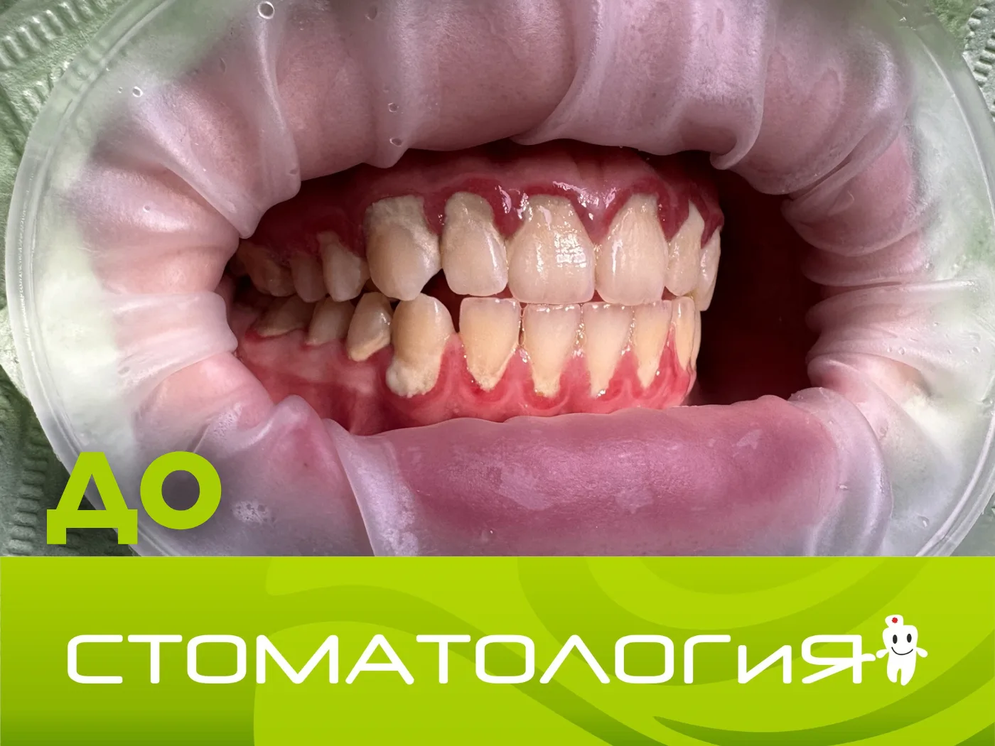 🦷 Пародонтит или «пародонтоз»? Разбираемся вместе
