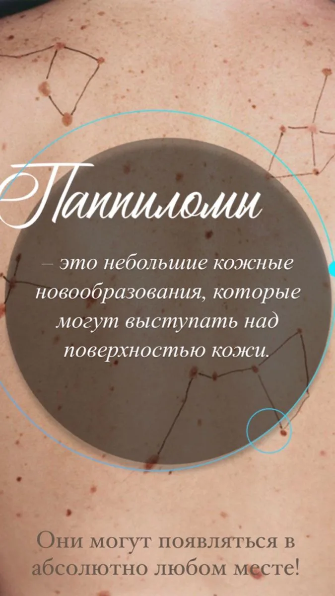 Сегодня поговорим про папилломы — тема действительно важная, и я постараюсь объяснить в...