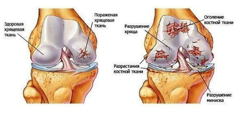Чудо рецепт от боли в суставах!!
