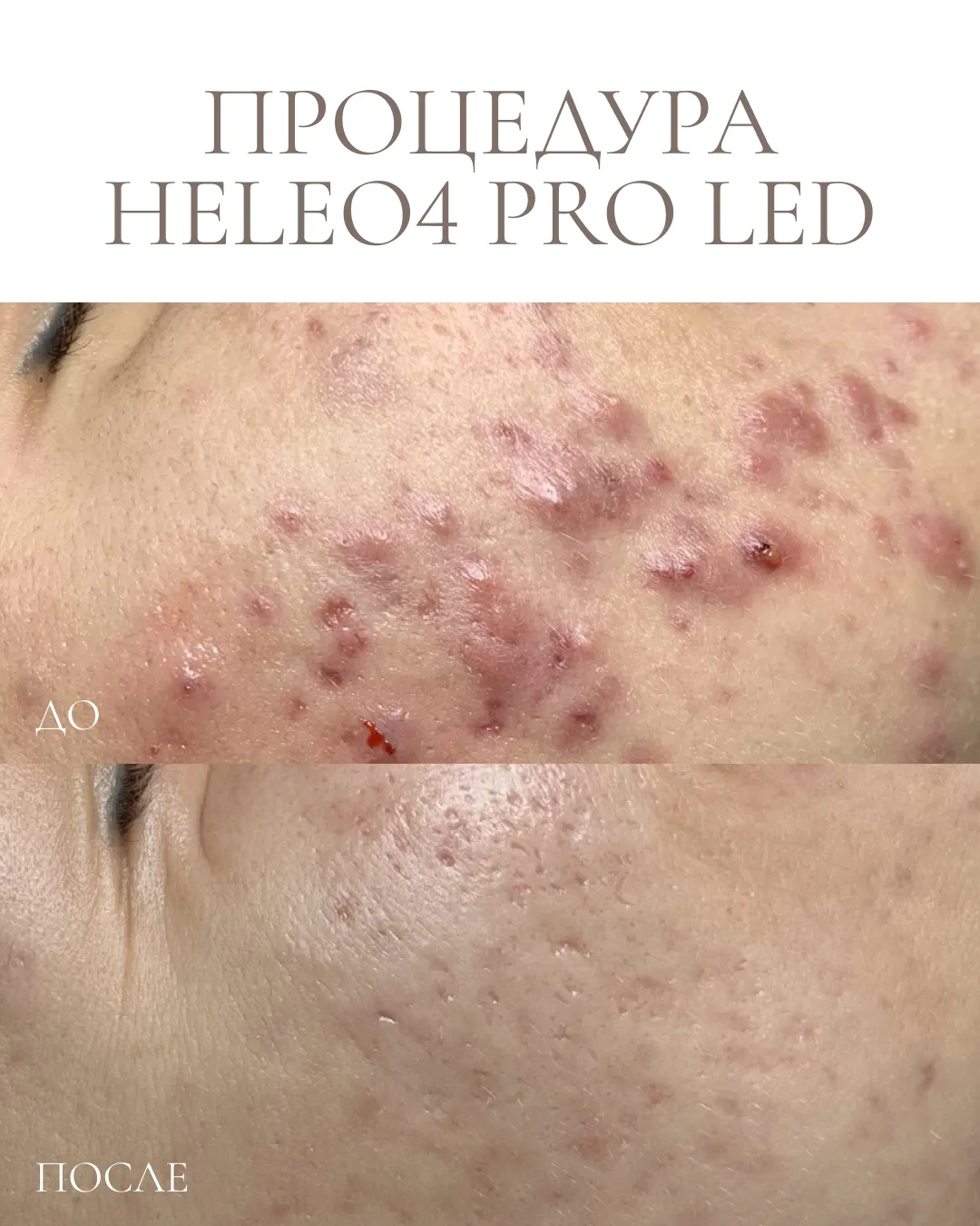 А какой результат я увижу от новой процедуры HELEO 4? 🤔