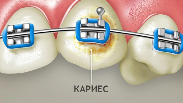 Девушка, 19 лет. Полтора года в брекетах, чистила электрической щёткой «для галочки».   Сняли систем