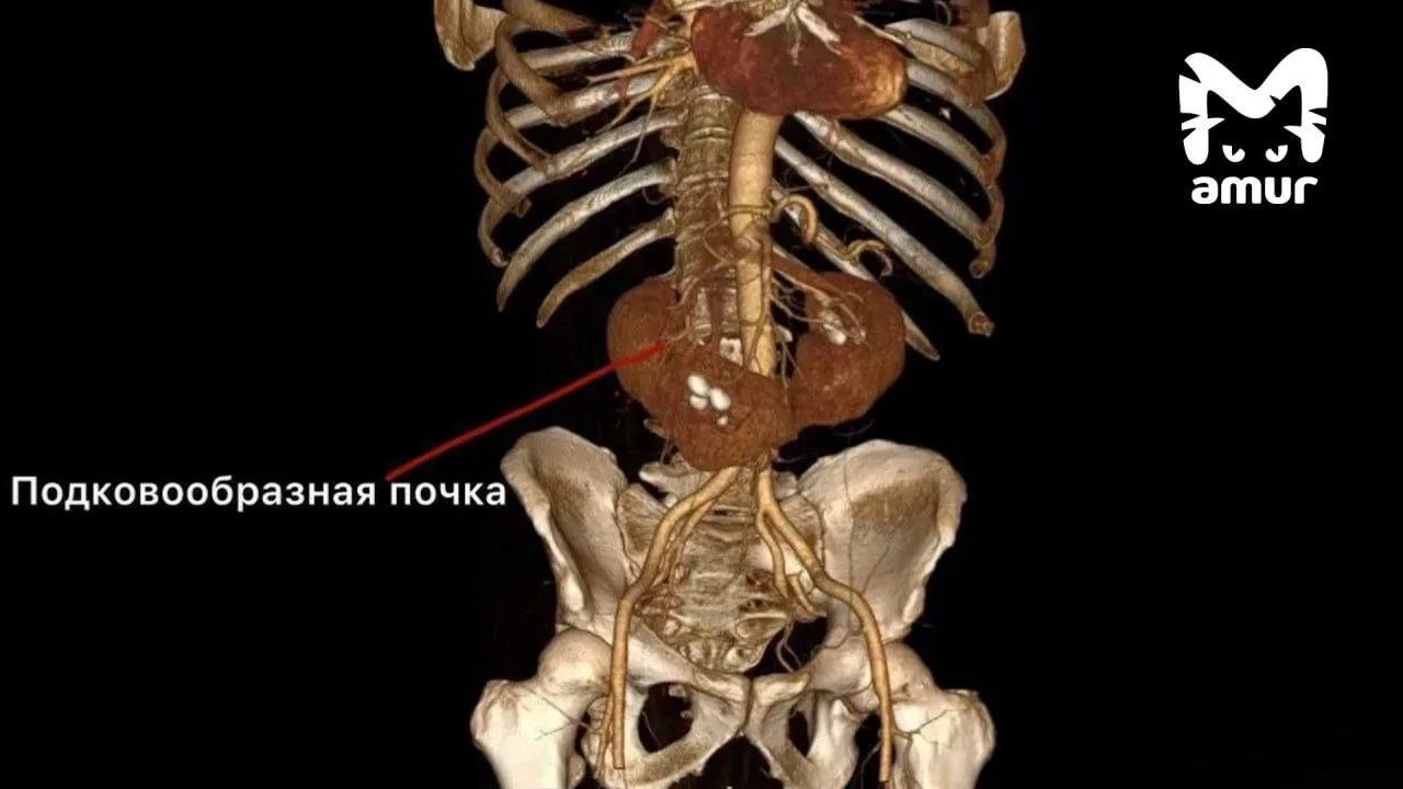 С почками в форме подковы полвека жил мужчина из Владивостока.