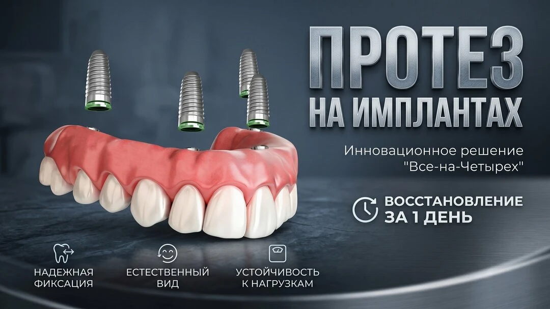 4 импланта + несъёмный протез за 1 день в Архангельске
