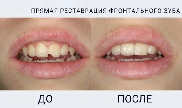 Сколько служит реставрация скола зуба