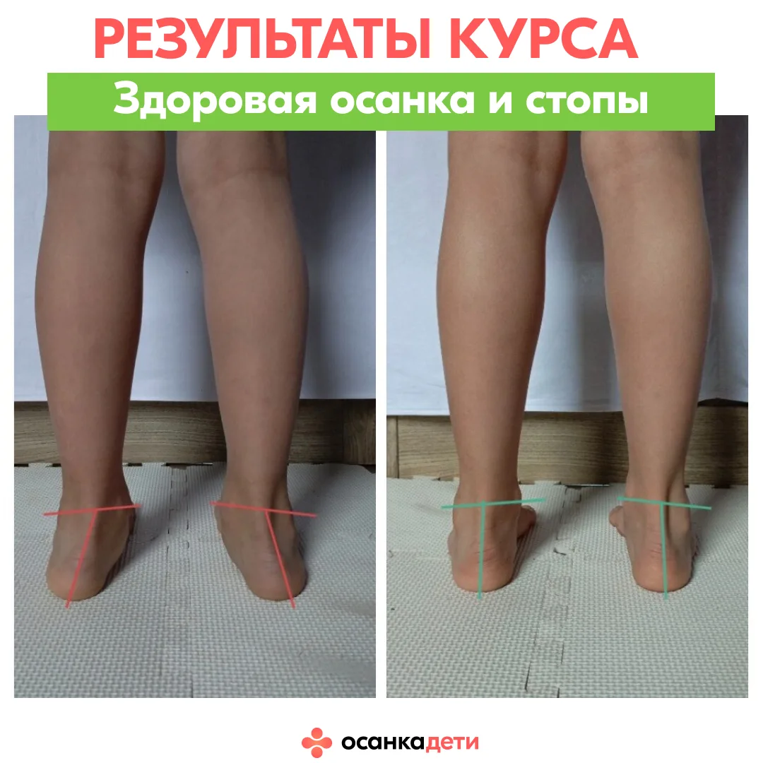 Его «до» — это стельки, «рукопашка» и ….  сутулость. После — смотрите в карусели результаты Савелия 