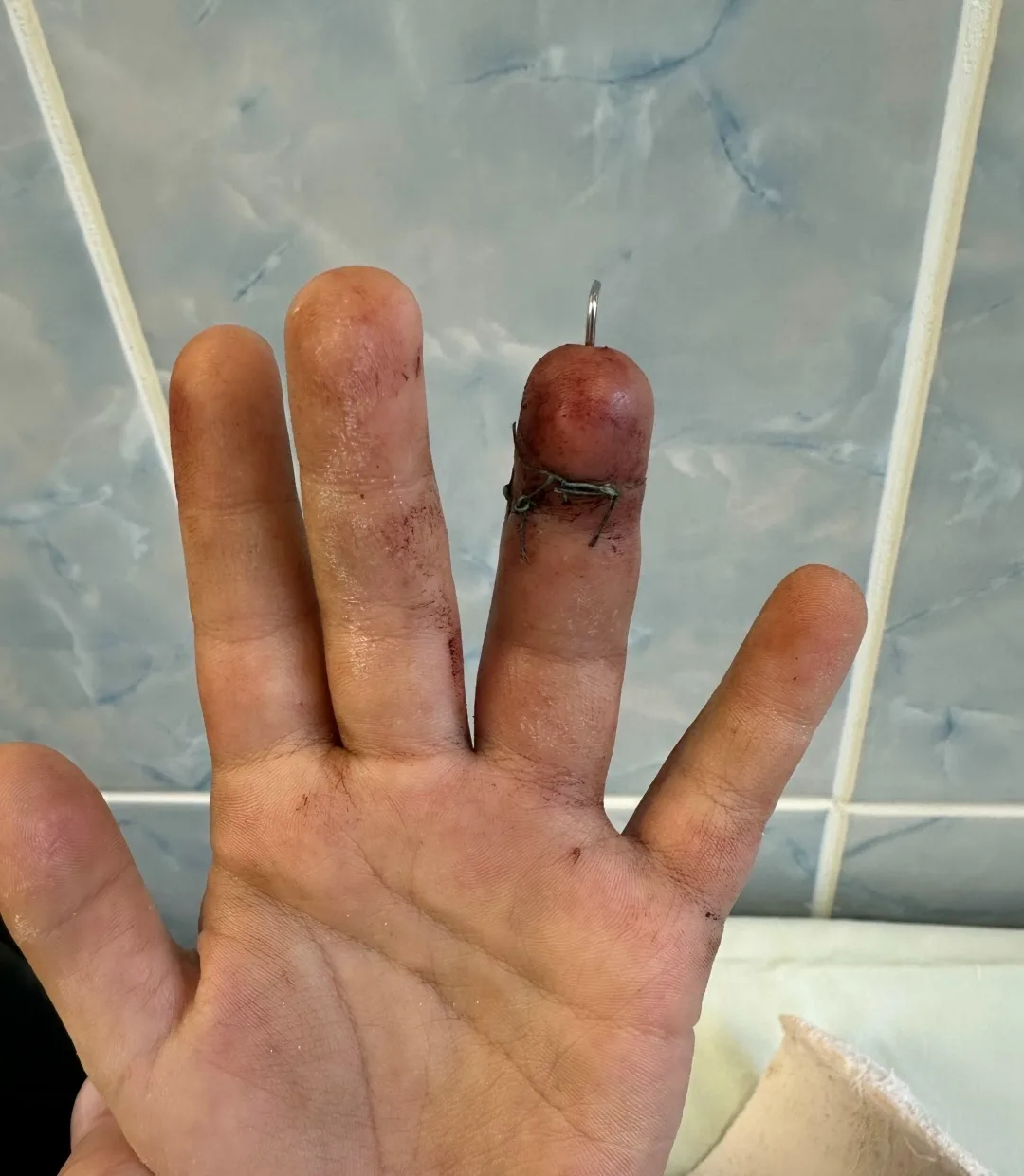 🖐 Шестилетний мальчик чуть не остался без пальца из-за электросекатора  Дачный сезон в самом разгаре