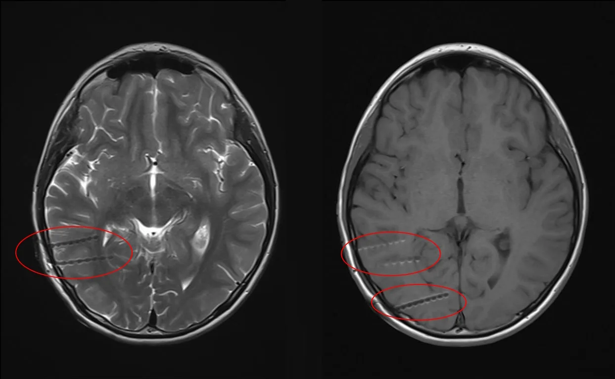 Нейрохирурги РДКБ спасли 12-летнего мальчика из Ставропольского края от тяжелой формы эпилепсии   🏥С