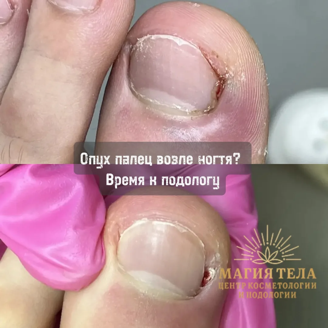 ⚠️ Красный, опухший и болезненный валик возле ногтя — что делать?