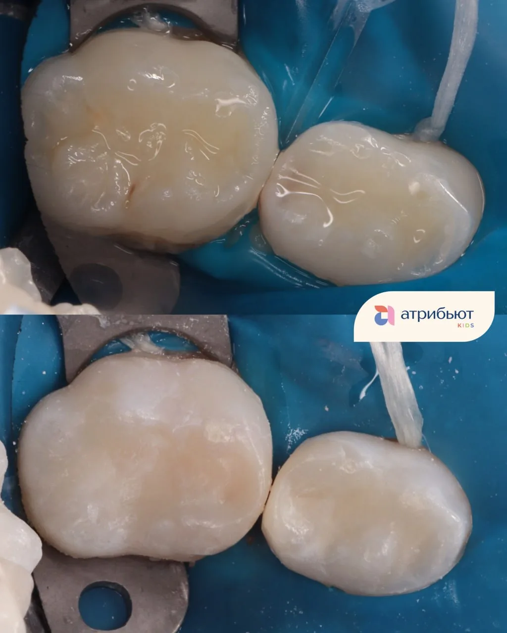 🦷 Когда кариес затрагивает сразу два зуба