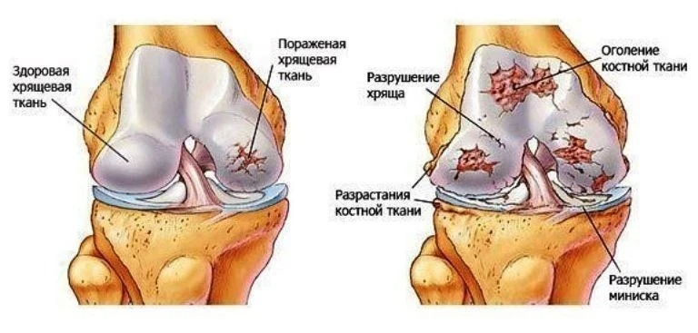 🌟 Простое решение для здоровья суставов!