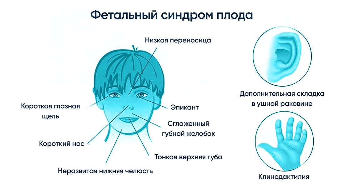Что такое фетальный алкогольный синдром