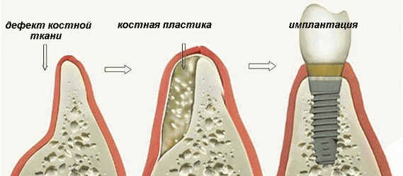 Костная пластика: когда нужна и зачем

После удаления кость атрофируется, для импланта не хватает об