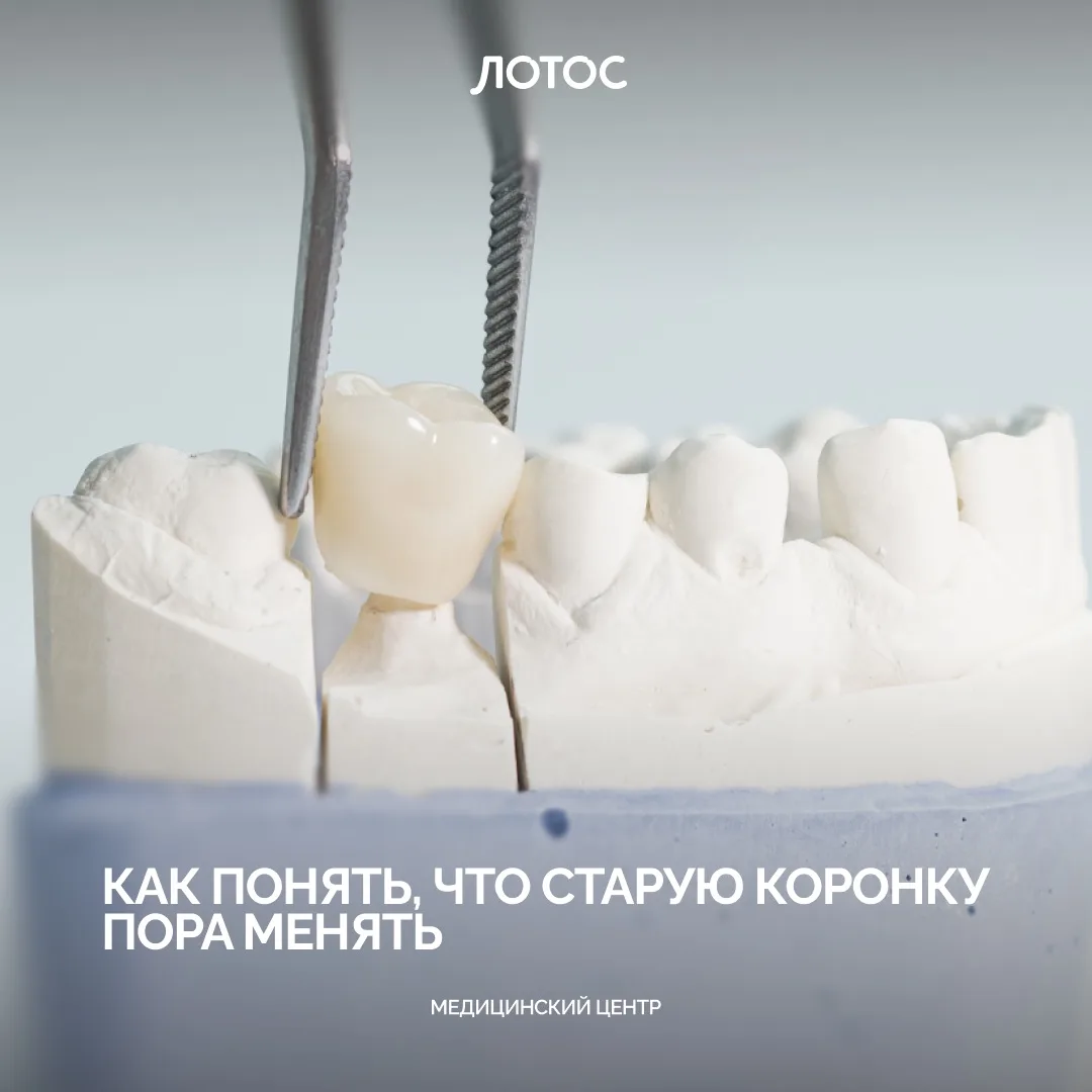 Многие считают, что если коронка не болит, значит, с ней всё в порядке. Но, как и любая...
