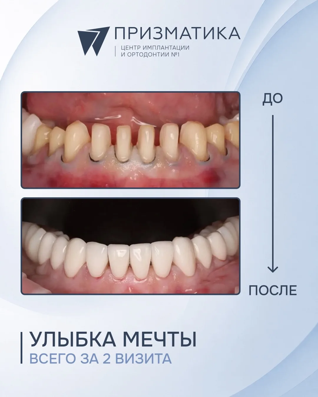 Керамические виниры IPS e.max по цифровому протоколу — точность, естественная эстетика и предсказуем