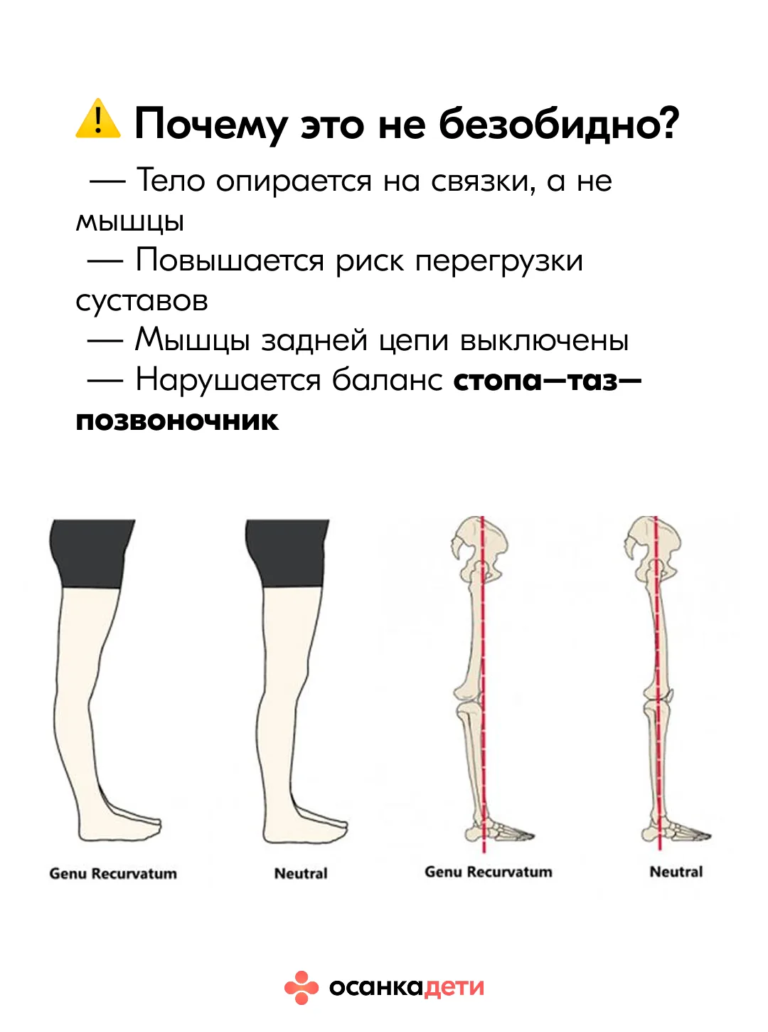 Колени-бананы 🍌 Насколько это опасно?  Переразогнутые колени у детей выглядят безобидно, и даже сейч
