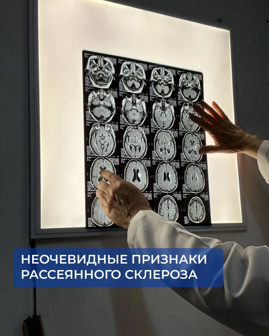 Неочевидные признаки рассеянного склероза.