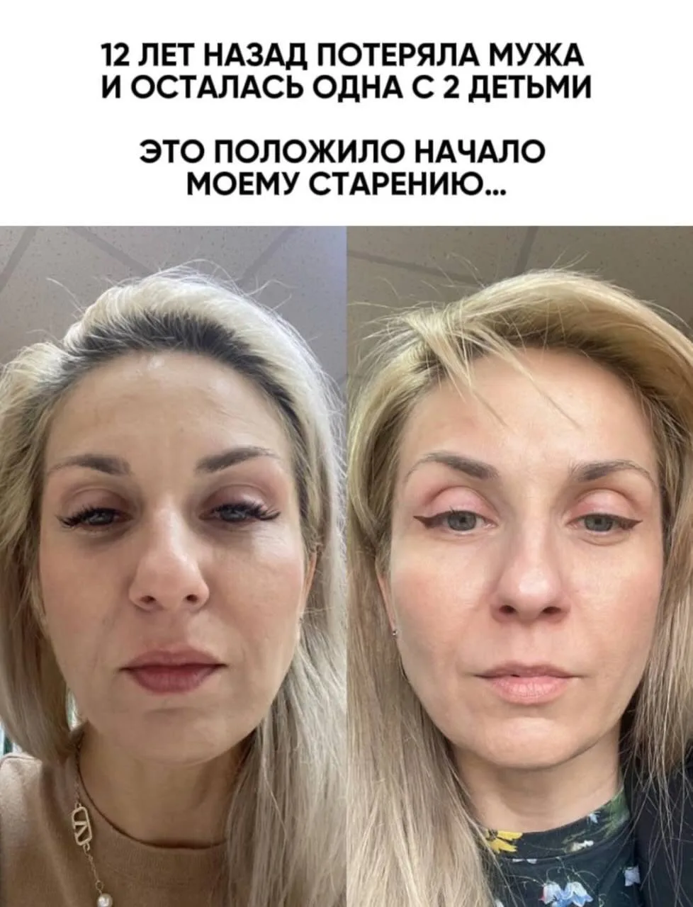 "В 32 кожа начала резко стареть и потемнела…" 💔