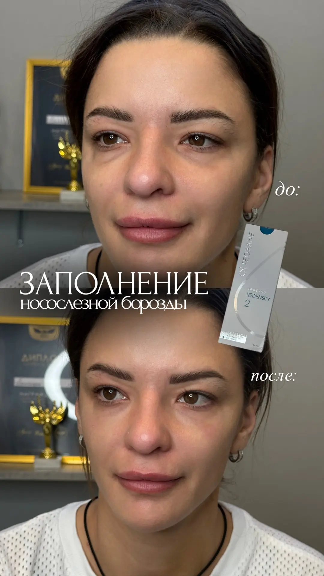 В 99% случаев - это Шикарная процедура ,которая дает мгновенный результат и свежий взгл...