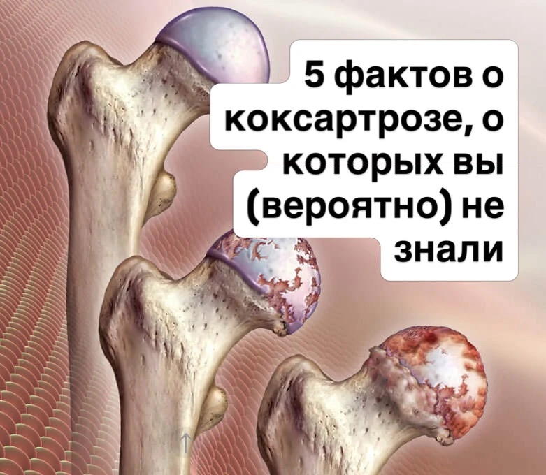 5 фактов о коксартрозе, о которых вы (вероятно) не знали

Все привыкли думать, что боль в паху при х