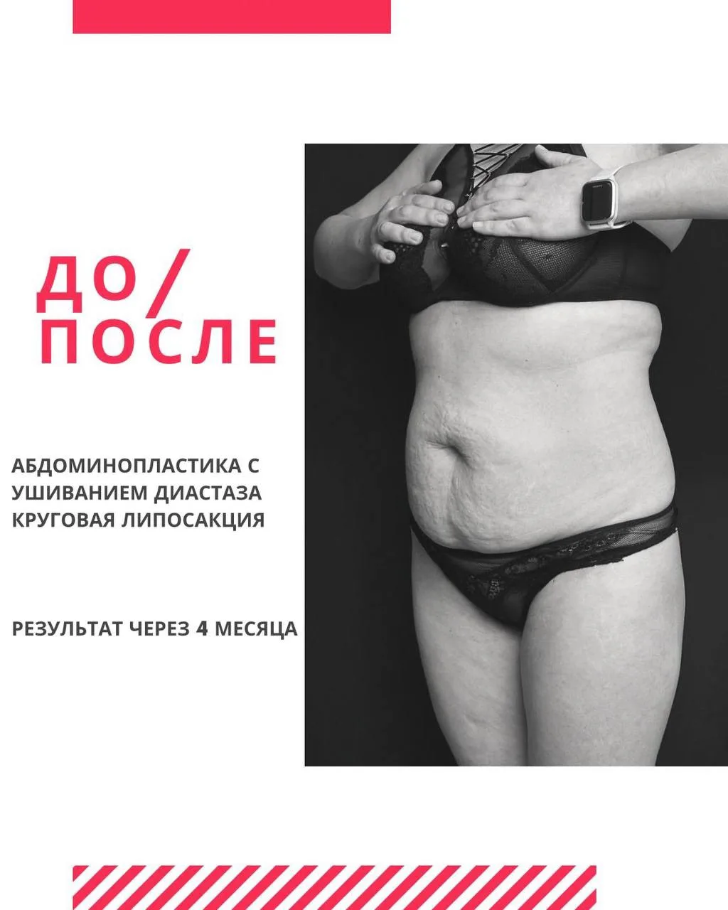 ✨Абдоминопластика + Круговая липосакция: результат через 4 месяца.