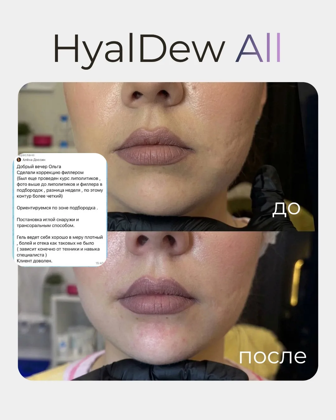 ✨ Первые впечатления косметологов Урала о новых филлерах HYALDEW