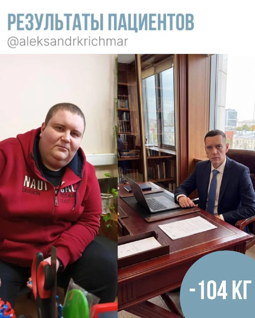 −104 кг за 14 месяцев — это огромный путь, сила воли и ежедневная работа пациента над с...