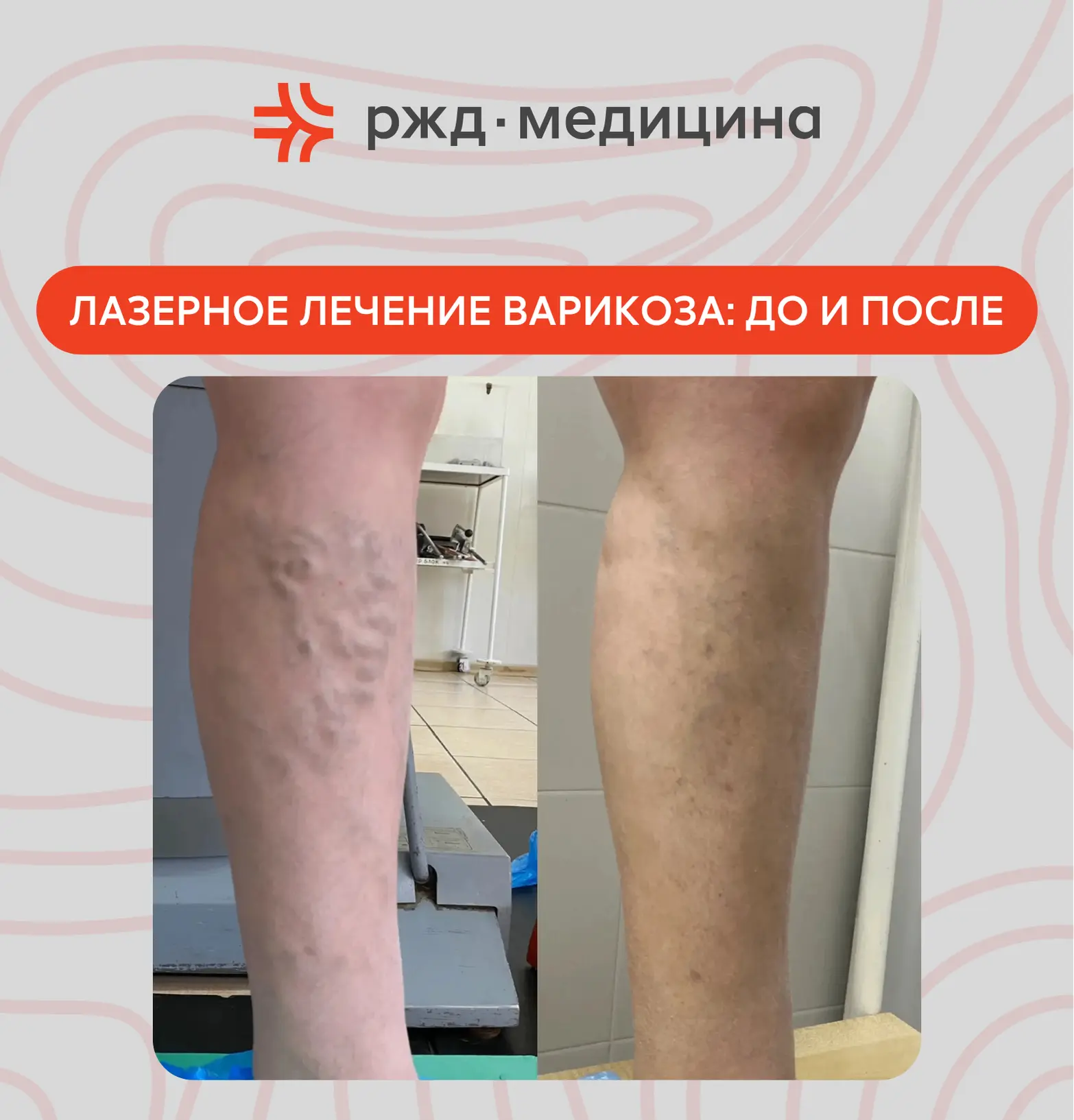 Результат, который говорит сам за себя: избавляемся от варикоза за 1 день!