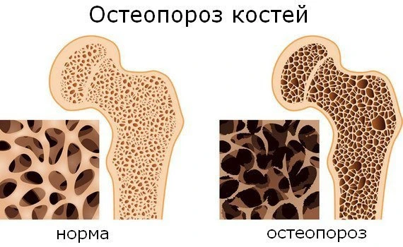 Общие рекомендации для лечения заболевания.  ✅Нужно исключить употребление продуктов, которые ускоря