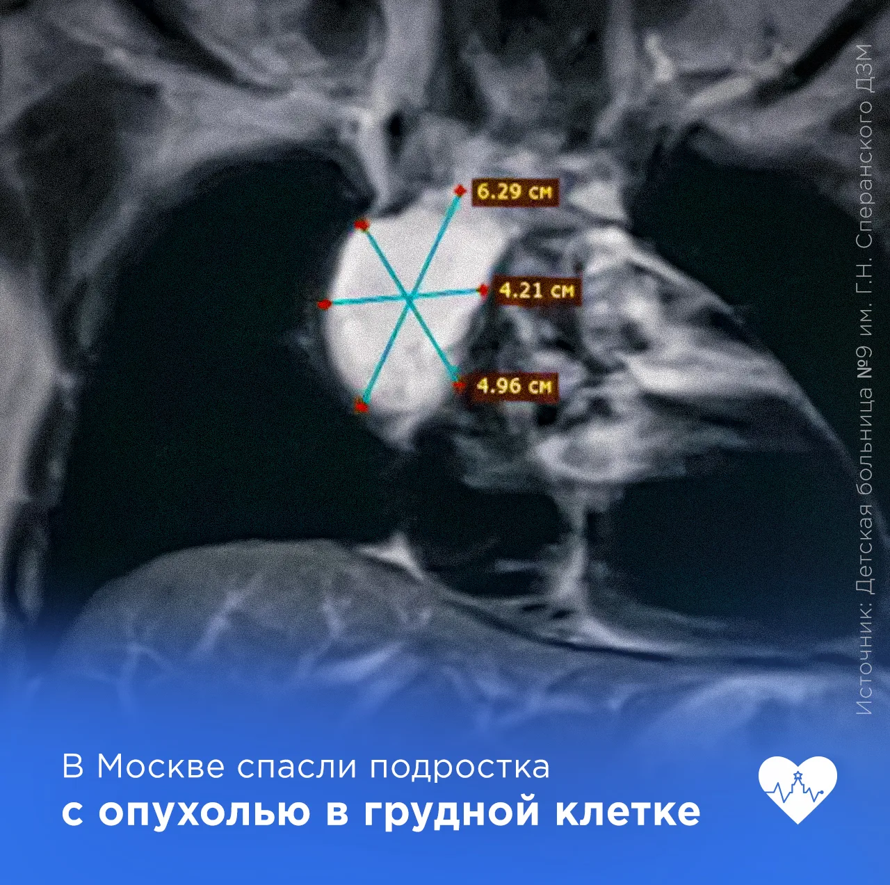 В Москве спасли подростка с опухолью в грудной клетке