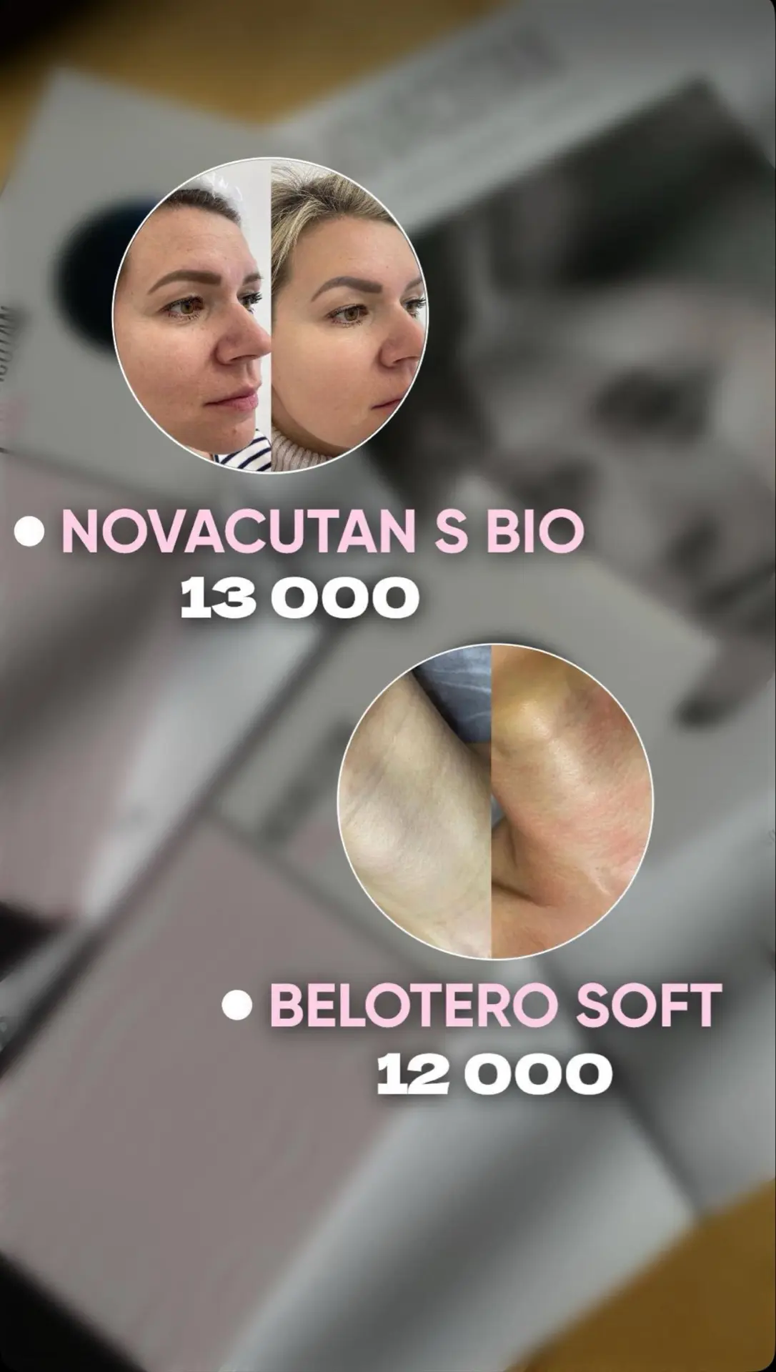 📍 Биоревитализация лица препаратом НОВАКУТАН - премиальный препарат по 5 точкам ✨
