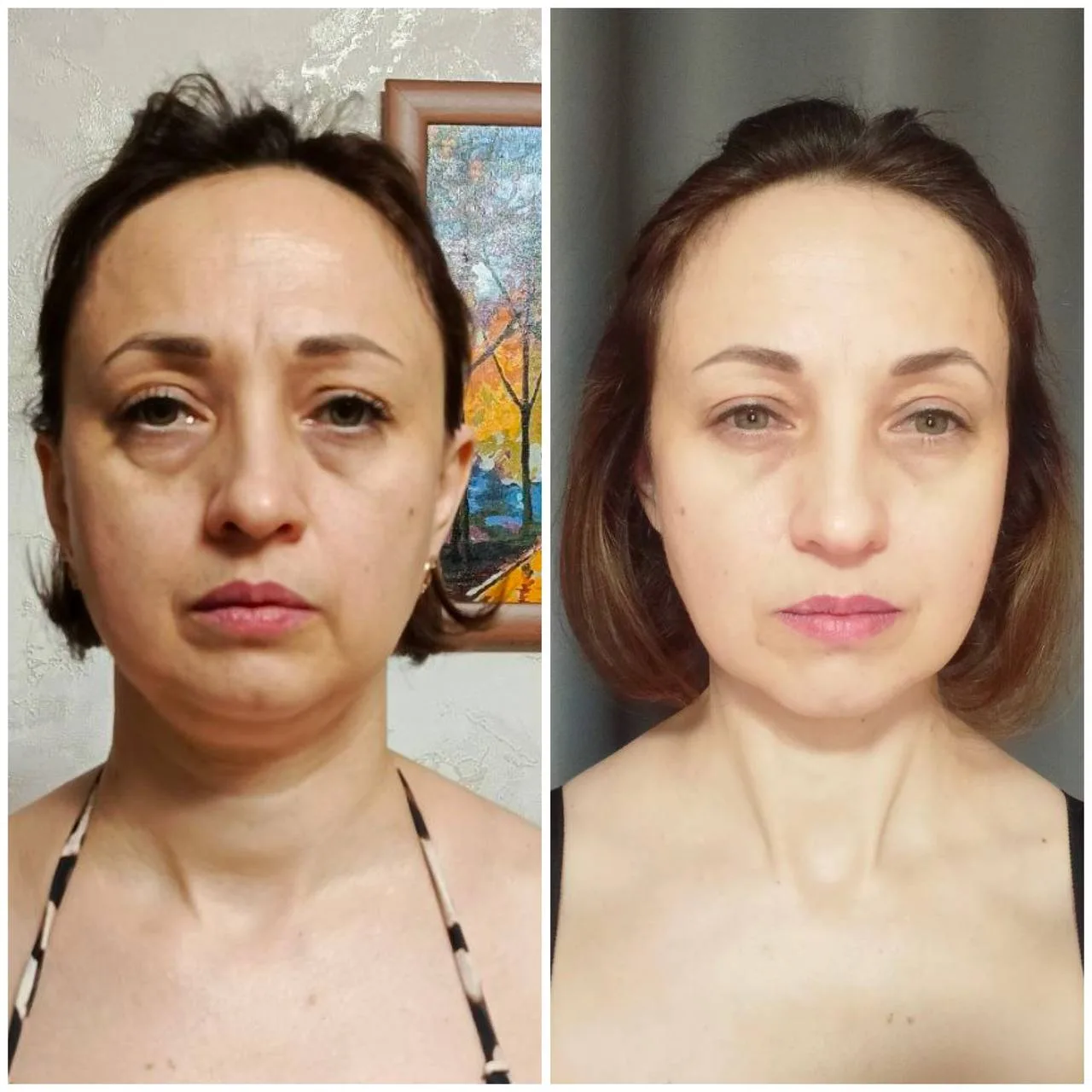 🔥Каких результатов можно достичь, если изначально была сделана диагностика осанки  Морщинки, возраст