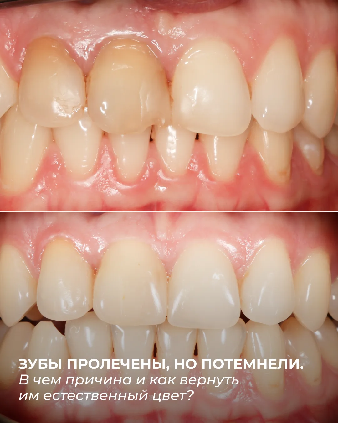Зуб вылечили от пульпита, поставили пломбу, а он… потемнел.
Как такое может быть и что делать?

Пуль