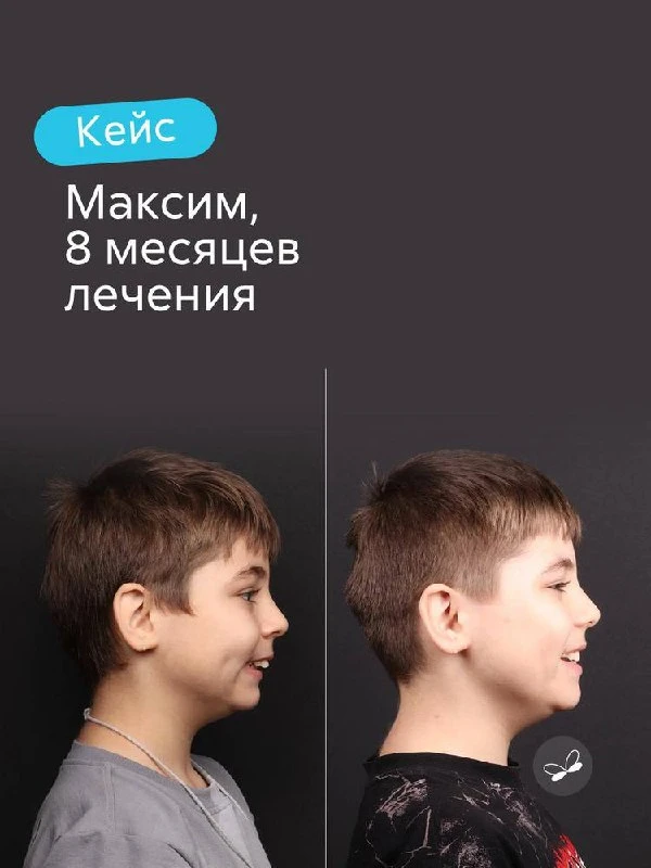 Раннее ортодонтическое лечение дает возможность работать на опережение. Пока ребенок ра...