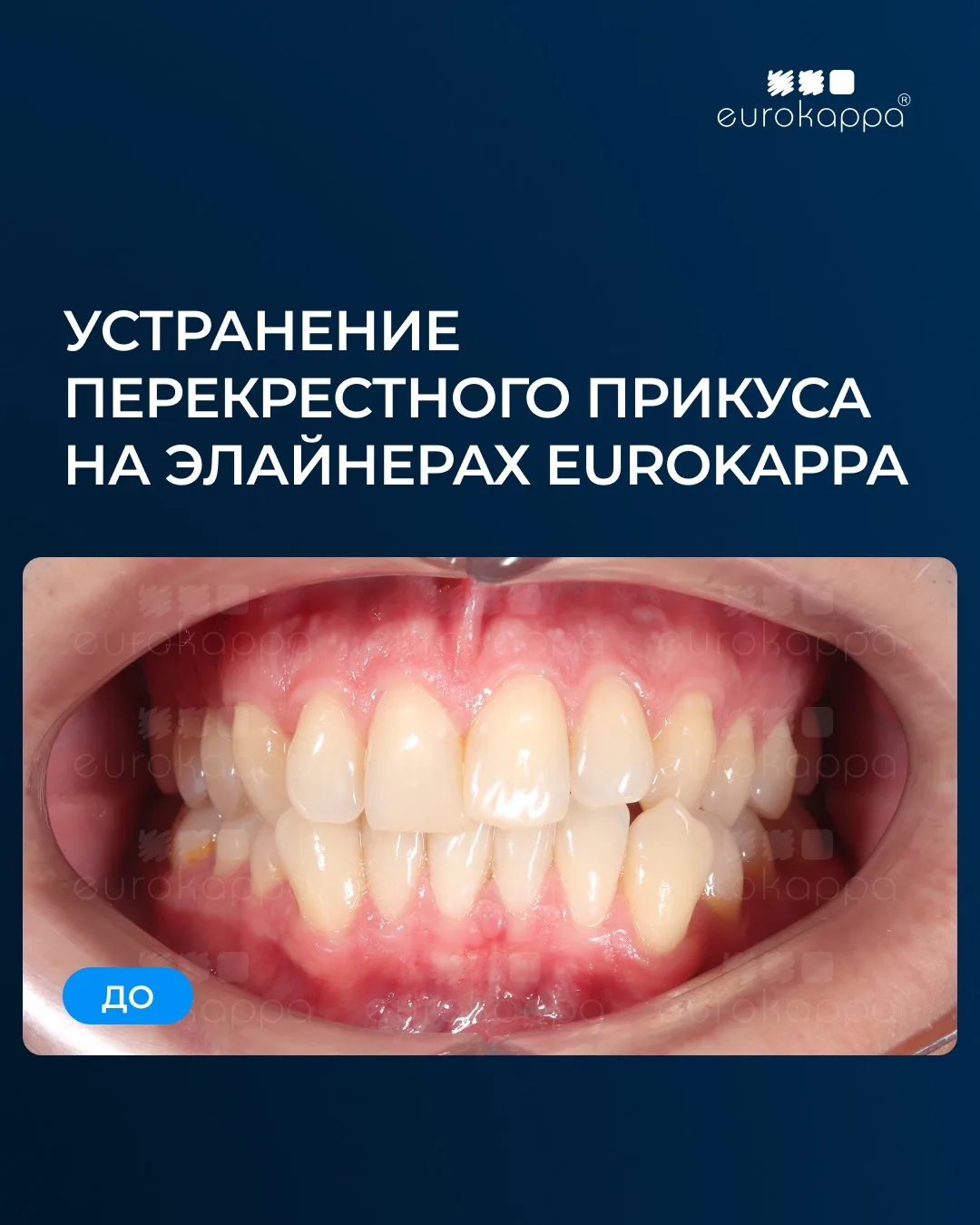 Кейс: Устранение перекрестного прикуса на элайнерах EUROKAPPA