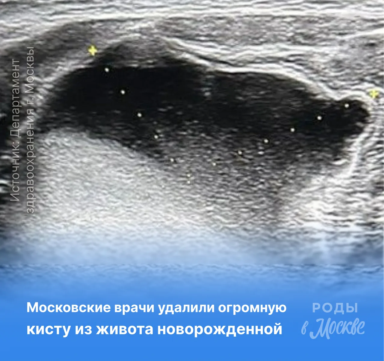 Московские хирурги спасли новорожденную девочку с огромной кистой ❤️‍🩹