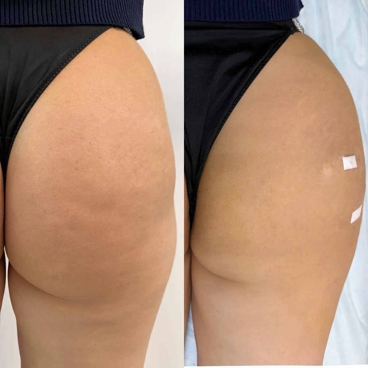 👆 Безоперационное увеличение ягодиц филлером B’de Beaute