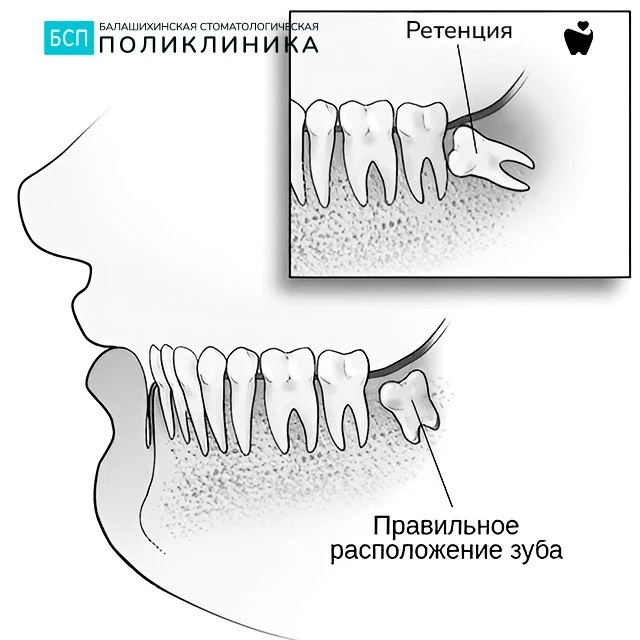 Что такое ретенция зубов? 🦷⏳