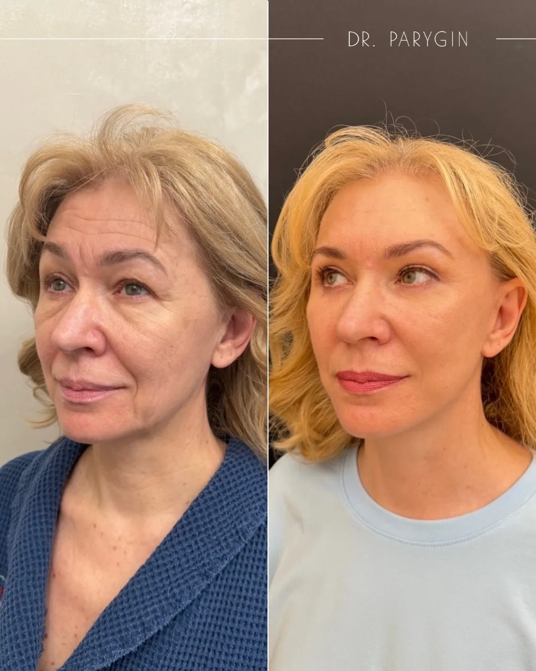 Deep Plane Facelift с липофилингом 😍