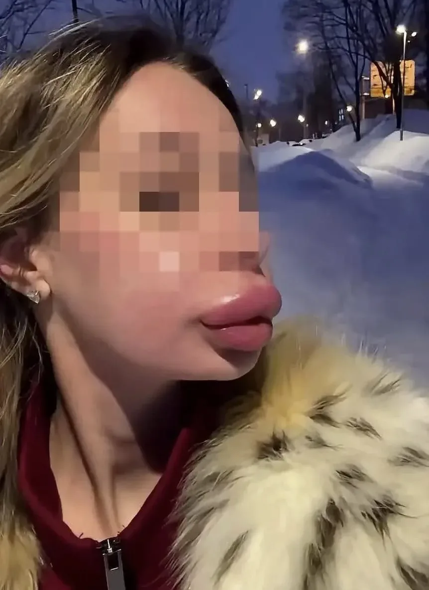 Девушка не могла принять свою внешность и десятки раз увеличивала губы — а когда решила...